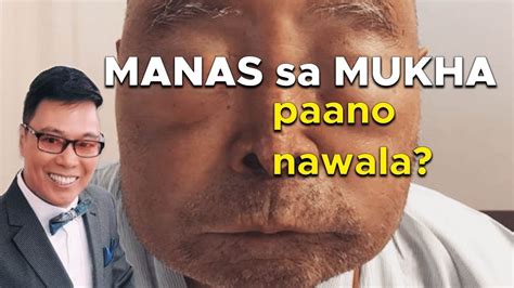 normal lang ba na 6months preggy pero <b>manas</b> na ang akin mga binti? kate. . Manas sa mukha